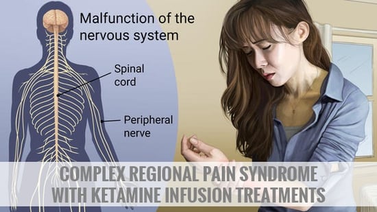 Complex Regional Pain Syndrome with Ketamine Infusion Treatments