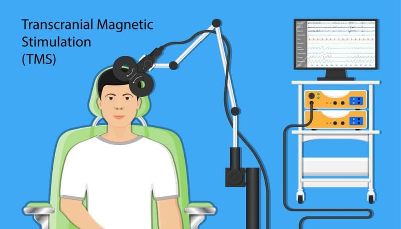 A graphic showing TMS treatment